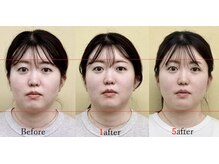 アプロ(APLO)/自律神経調整＋小顔矯正