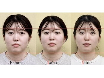 アプロ(APLO)/自律神経調整+小顔矯正