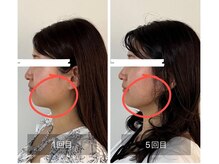 鍼灸院 はりのひと/美容鍼5回の変化！