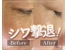 【5周年/5名限定】美容鍼×インディバ小顔フェイシャル¥15000→¥5980