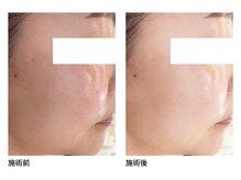 オーシャンブルー 長崎店(OCEAN BLUE)/美白・シミケア