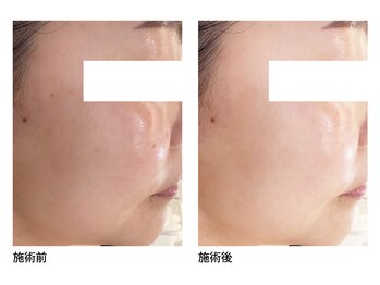 オーシャンブルー 長崎店(OCEAN BLUE)/美白・シミケア