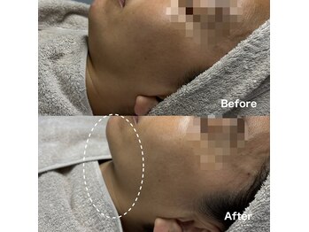 アンド(and...)/小顔・たるみケア◎レモンボトル