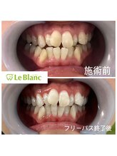 ルブラン 奈良店(Le Blanc)/夏前にホワイトニング！