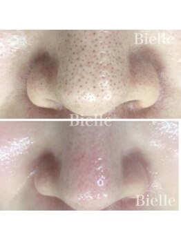 ビエル(Bielle)の写真/《皮膚科提携》世界初*毛穴汚れ驚く程取れる【ナノ分子レベルの毛穴洗浄＆ビタCヒト幹水光ショット¥12500】