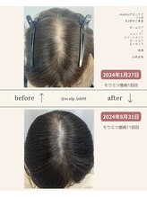 スカルプラボ(Scalp Lab)/moumitu7ヶ月症例