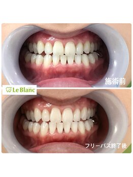 ルブラン 奈良店(Le Blanc)/フリーパスで理想の白さに!