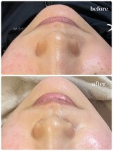 ニコリ(Nicori)/シェービングエステ