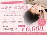 【肌バリア強化】ニキビ・赤み改善 ￥8,000→