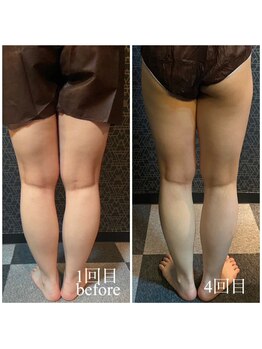 ラクラク(rakuraku)/下半身痩身【脚】1~4回目