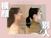 ジェイミー(Gemiey)/食いしばり、二重顎でお悩み