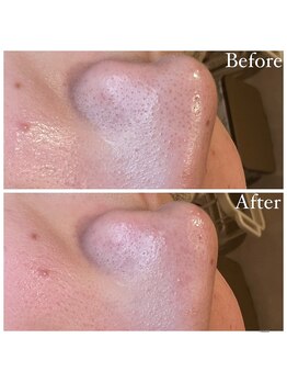 マドモアゼル 麻布十番/毛穴洗浄