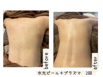 ナースセレクトサロン(Nurse select salon)/背中の肌荒れ改善