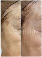 ローズフィールド(Rosefield)/80代　シミ（10ヶ月）