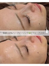 サロンベイア(salon Beia)/国産100%ハーブピーリング