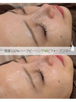 サロンベイア(salon Beia)/国産100%ハーブピーリング