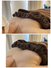 スマイルクルー(SmileClue)/初回ビフォーアフター症例