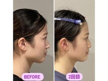 小顔22 ボルティ 赤坂支店(Bolty)/20代：小顔シンメトリー（2回）