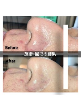 ポアレスサロン フィル(fil)/アルティメイトトリートメント後