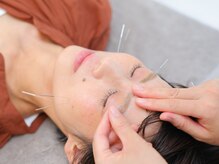 鍼灸イズンの雰囲気（表情筋にアプローチし動かしやすくなる電気を流す美容鍼です。）