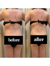 レミュービューティー(Remieux beauty)/befor/after