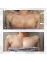 アカシア(acacia)/女性らしいふんわりバストへ◎