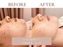 サエラ(SAERA)/ニキビ改善ケア【6回】