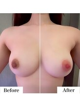 ルネル(Lunelle)/韓国式メラニンケア《乳輪》