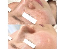 アンノン(Annon)の雰囲気（超希少☆臍帯&羊膜幹細胞で深層から光が満ち溢れる水光リフト）