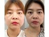 人気No.1秒速小顔リフト全顔（韓国で話題の最新マイクロ波マシーン）
