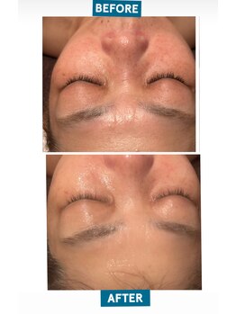 リ シェリール(Re cherir)/ヒト幹細胞50%導入