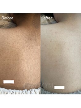 グレーシス(Graces)/全身脱毛(背中)