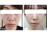 人気No.３【潤水光肌＆リフトUP】ハーブピーリング×光フェイシャル×生コラ
