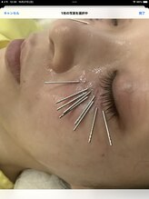 スプーノ 神楽坂(Spoonno)/ヒト幹細胞30%美容液と美容鍼