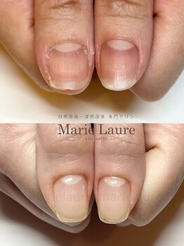 マリーロール 淀屋橋本店(Marie Laure)/自爪育成/深爪矯正/ネイルケア