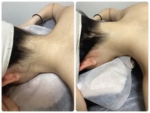 ルルトウキョウ 池袋店(LULU.tokyo)/うなじ脱毛