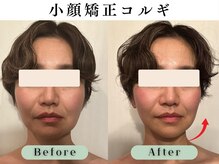 スイスパ 恵比寿(翠SUI SPA)/【小顔矯正コルギ】Before/After
