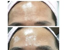 ワミ 八潮(WAMI)/毛穴洗浄&ララピール(全顔)