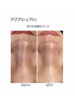 ソワン(Sowan)の写真/愛媛初アクアシュアＨ2◇美肌づくりは毛穴洗浄から◎毛穴開き/黒ずみ/ごわつきを改善し毛穴レスツヤ肌に♪