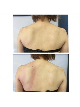 リベル(Liber)/筋膜リリース/肩甲骨痛み軽減