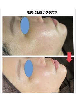 リバイブ(REVIVE)/毛穴も飛ぶよ！