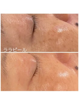 ヒーリングサプリ(Healing Supple)/ララピール