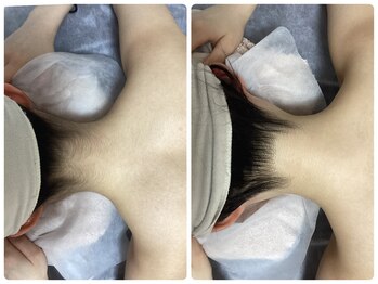 ルルトウキョウ 池袋店(LULU.tokyo)/うなじ脱毛