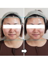 きしの美容整体院/フェイシャルリフトケアBA