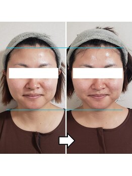 きしの美容整体院/フェイシャルリフトケアBA