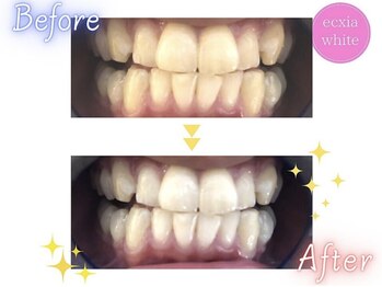 エクシアホワイトニング エミフルMASAKI店/ホワイトニングビフォーアフター