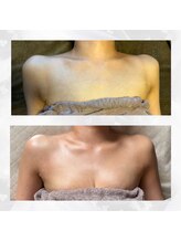 アカシア(acacia)/【A→Cカップ】胸に脂肪が欲しい