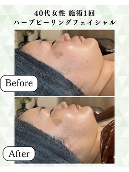 シーフェイス 横浜店(SEE FACE)/毛穴肌質改善ハーブピーリング