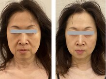 ドクターボディクリスタル(Dr.Body Crystal)の雰囲気（ダウンタイムなく、自然なリフトアップでナチュラルに美しく）