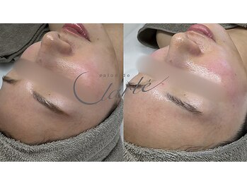サロン ド クラルテ(salon de clarte)の写真/透明感とツヤ爆誕☆余分な角質や、産毛を除去し気になる毛穴の汚れをOFF♪